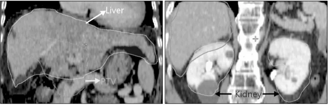 Fig.  3.  Example  of  PTV  and  OARs  in  ITV-IMRT  plan  delineated  in  MIM  program  reflecting  the   respi-ratory  motional  effect.