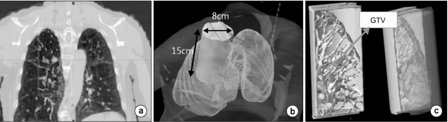Fig.  1.  CT  image  based  3D  Phantom  design  using  the  Eclipse  RTP  system.  (a)  Frontal  image  for  a  lung  cancer  patient