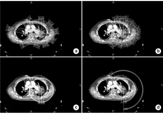 Fig.  1.  Comparisons  of  the  IMRT  and  VMAT  with  equally  ((a);  (c))  or  partially  ((b);  (d))  beam   arrange-ments