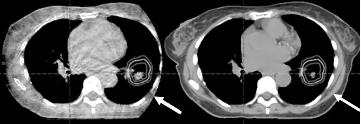 Fig.  5.  Truncation  of  CBCT  contour  (left).