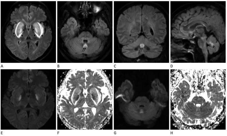 Fig. 1. Uremic encephalopathy in a 50-year-old man. 