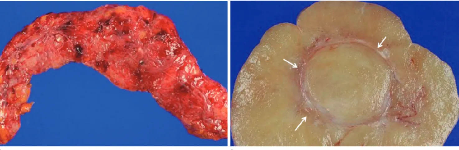 Fig. 3. Gross specimen (A) of appendix is displaying enlarged, consolidated, and transmural firm mass lesion in whole appendix