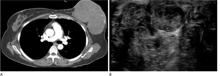Fig. 6. Malignant phyllodes tumor. 