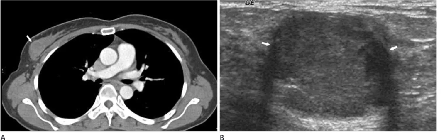 Fig. 8. Medullary carcioma. 