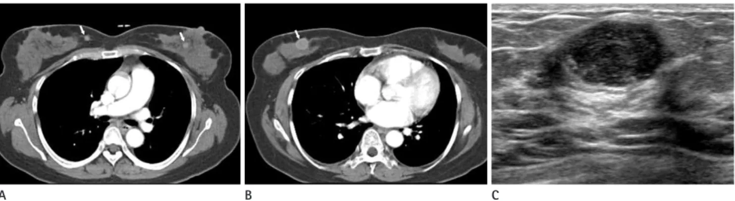 Fig. 12. Melanoma metastasis. 