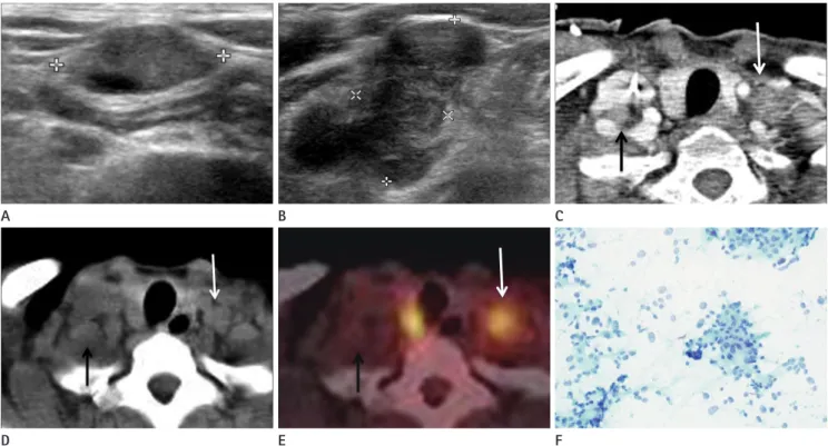 Fig. 2. A 52-year-old woman with thyroid cancer and false negative interpretation at  18 F-FDG PET/CT