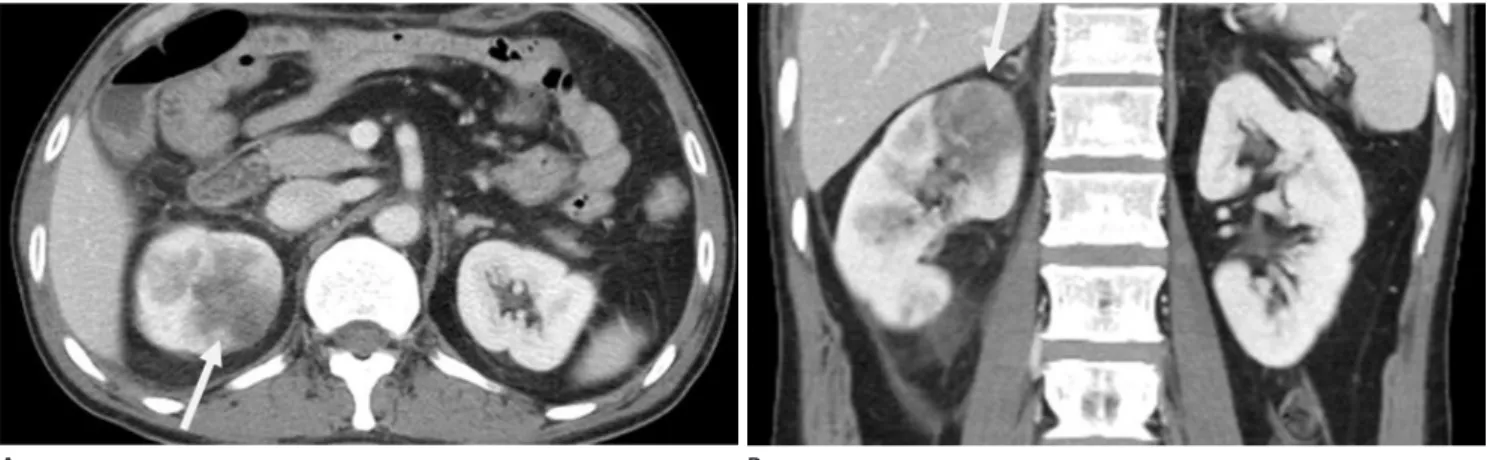 Fig. 6. A 48-year-old man with acute pyelonephritis (D-dimer: 932 ng/mL). 