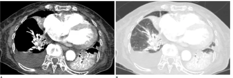 Fig. 7. A 79-year-old man with pneumonia and parapneumonic effusion (D-dimer level: 930 ng/mL)