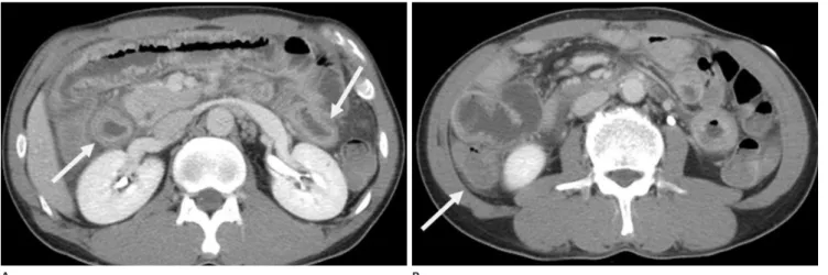 Fig. 10. A 67-year-old man with infectious pericarditis (D-dimer level: 