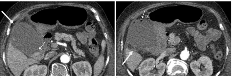 Fig. 11. A 81-year-old woman with gallbladder empyema (D-dimer level: 2,675 ng/mL). 