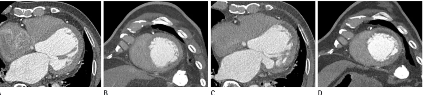 Fig. 13. A 84-year-old man with acute myocardial infarction (D-dimer level: 344 ng/mL).