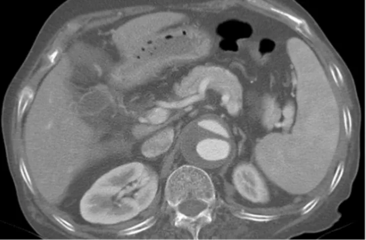 Fig.  15. A 69-year-old woman with elevated serum D-dimer level  (1,238 ng/mL). Axial CT chest scan shows an intimal flap with two  sep-arated lumens in the dilated abdominal aorta suggesting aortic  dis-section