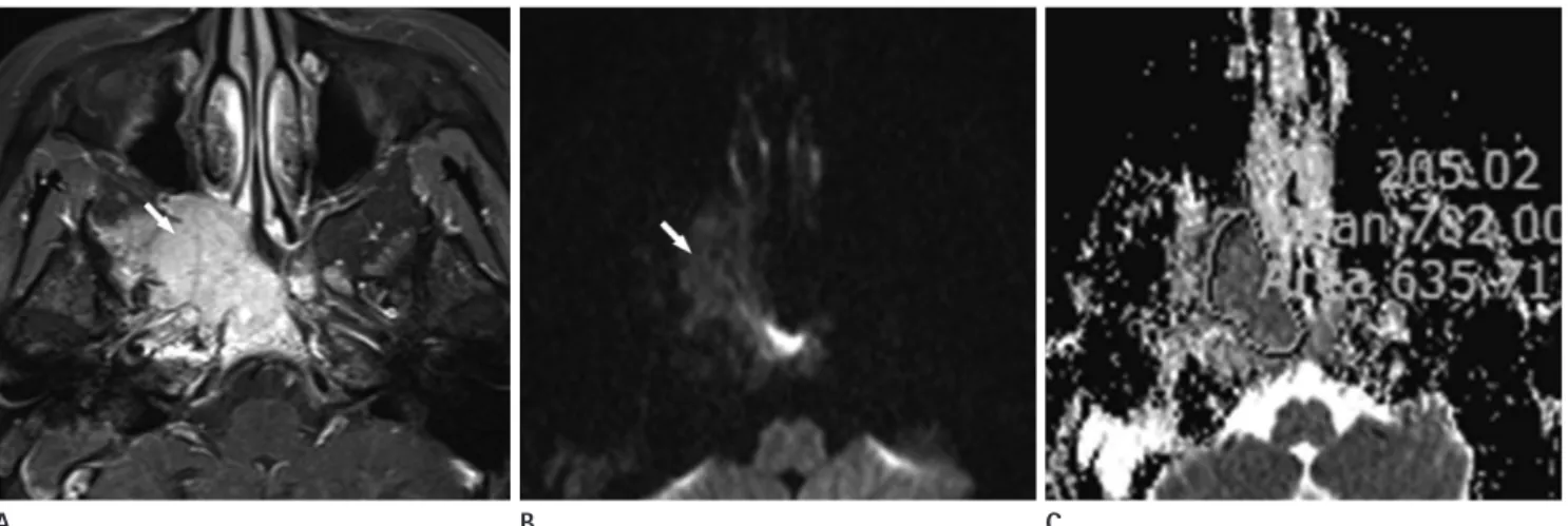 Fig. 4. A 47-year-old male, diffuse large B cell lymphoma of the tongue base. 