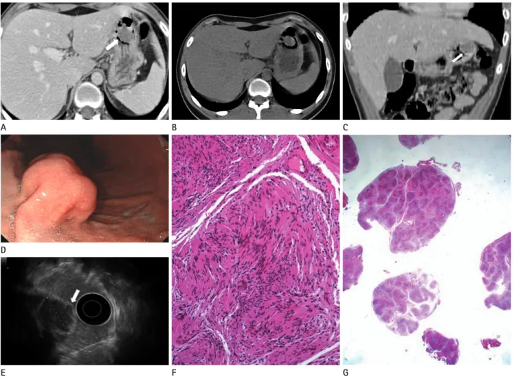 Fig. 1. Plexiform schwannoma of the stomach associated with NF2 in an 18-year-old male