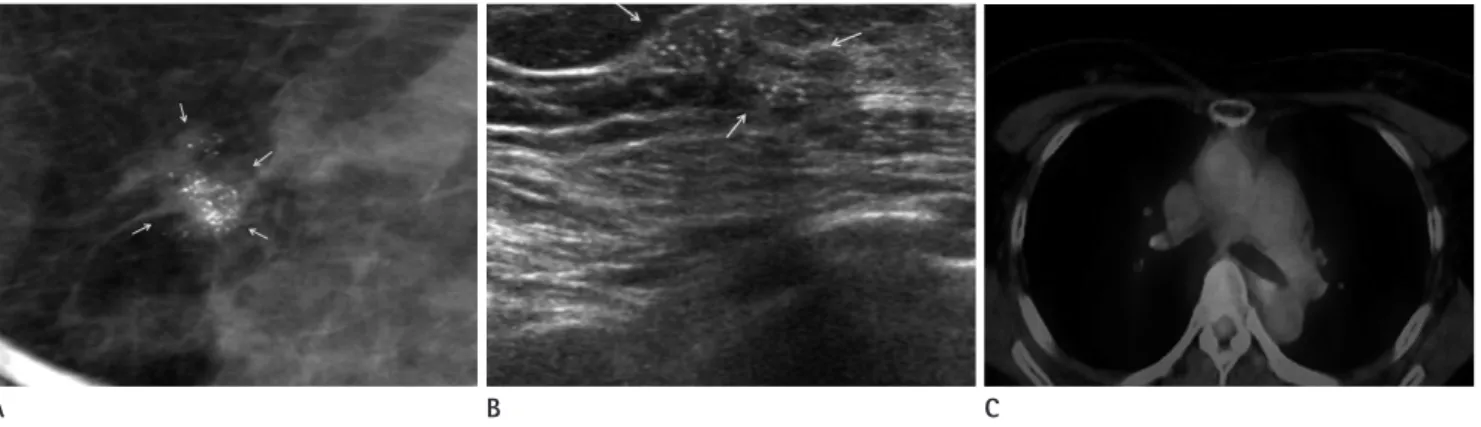 Fig. 4. A 49-year-old woman having 7 mm IDC with PET/CT negative. 