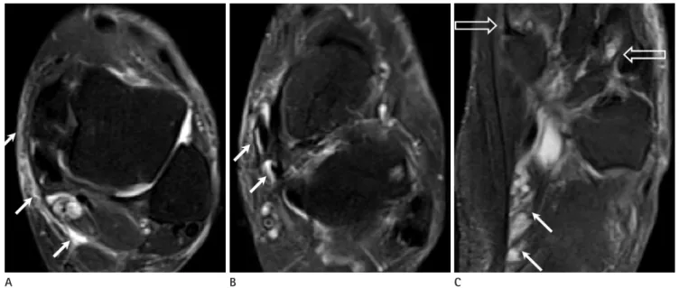 Fig. 11. Normal anatomical course of the lateral plantar nerve. 