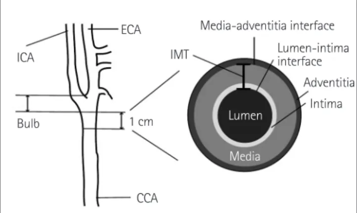 Fig. 1. The carotid artery intima-media thickness (IMT) is defined as a  distance between lumen-intimal interface and media-adventitia  inter-face at the wall of carotid artery