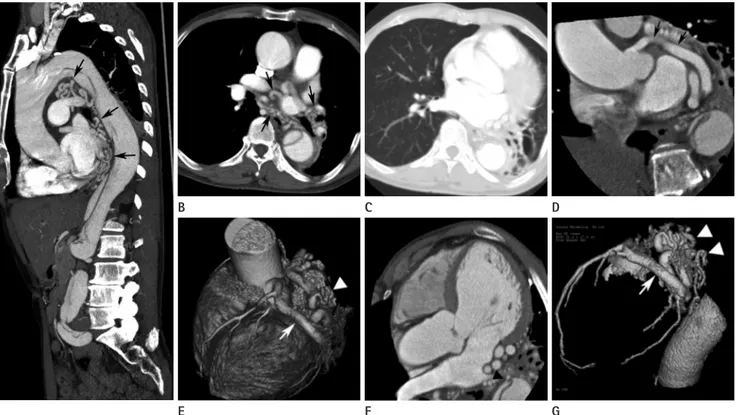 Fig. 1. A 64-year-old man with a coronary-to-bronchial artery fistula and dissecting aortic aneurysm