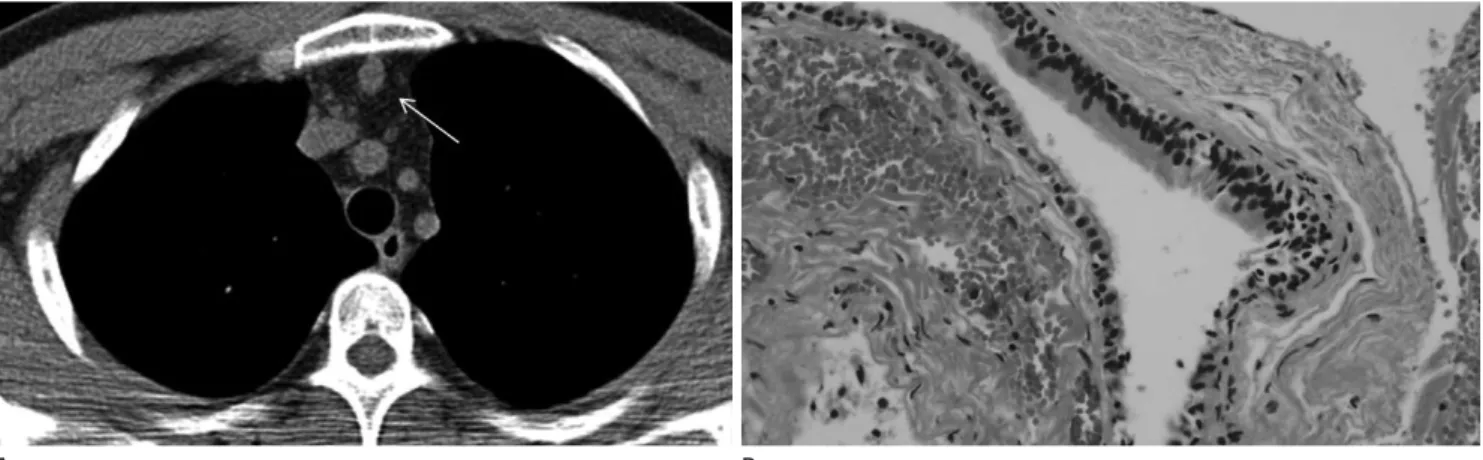 Fig. 1. Bronchogenic cyst in a 43-year-old asymptomatic man. Transverse view of non-contrast enhanced chest CT scan (mediastinal window  settings) (A) shows a well-circumscribed homogenous soft-tissue attenuated (ROI = 35 HU, SD = 19.15) lesion (arrow) in 