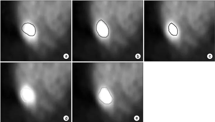 Fig.  1.  Applying  automatic  image  segmentation  in  PET  image.  (a)  CT  based  GTV,  (b)  relative  threshold  method  (40%),  (c)  relative  threshold  method  (50%),  (d)  gradient  method,  and  (e)  region  growing  method.