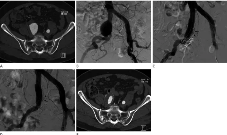 Fig. 1. Imaging results of a 77-year-old patient with a right common iliac aneurysm initially measuring 36 mm who underwent stent graft  placement with coil embolization of the internal iliac artery