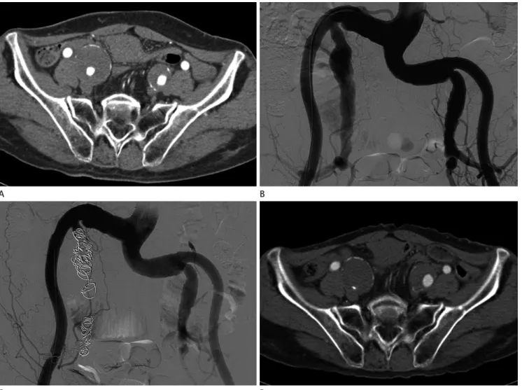 Fig. 2. Imaging results of a 68-year-old patient with a right internal iliac aneurysm initially measuring 40 mm who underwent coil embolization