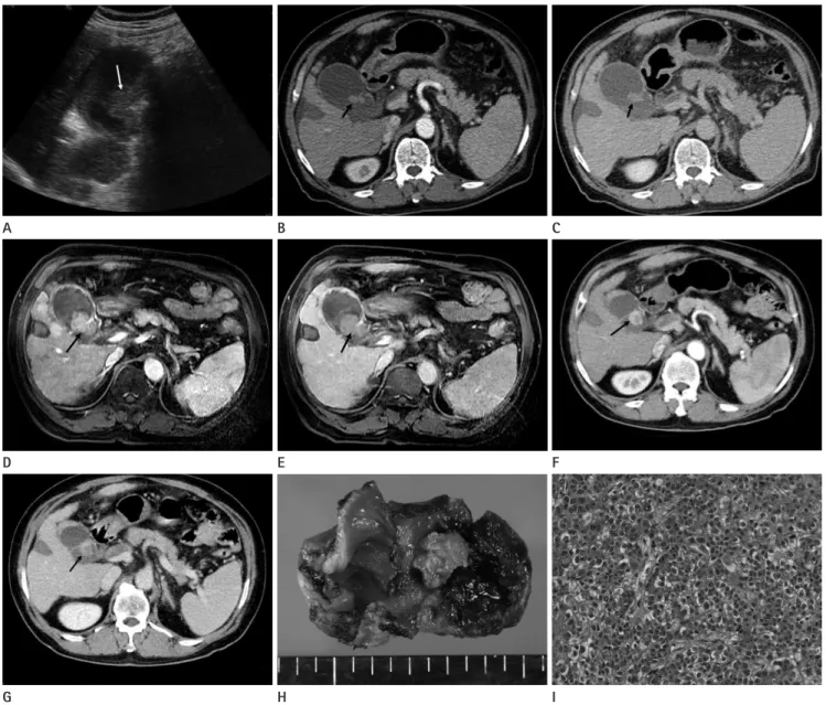 Fig. 1. A 62-year-old man presenting abdominal pain in right upper quadrant. 