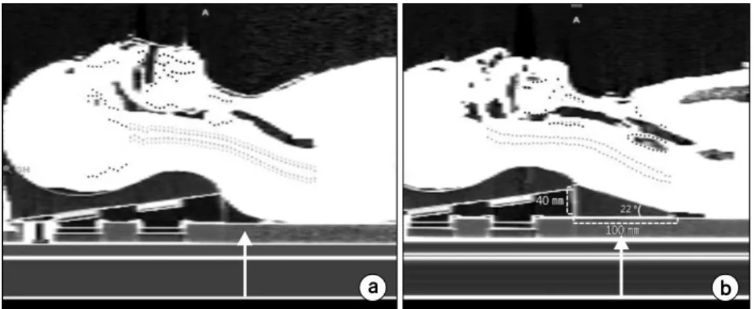 Fig.  1.  The  sagittal  view  of  kVCT  image  (a)  with-  and  (b)  without  using  an  aid-pillow