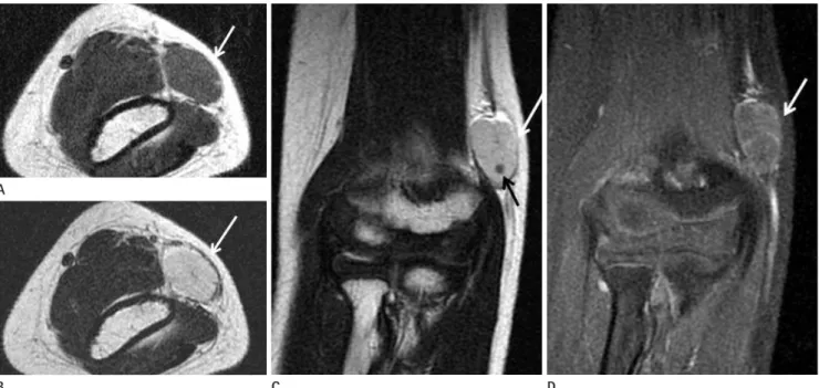 Fig. 2. MR imaging findings for the case study. Axial (A) T1-weighted SE image (TR: 450, TE: 11) shows an isointense mass (arrow)