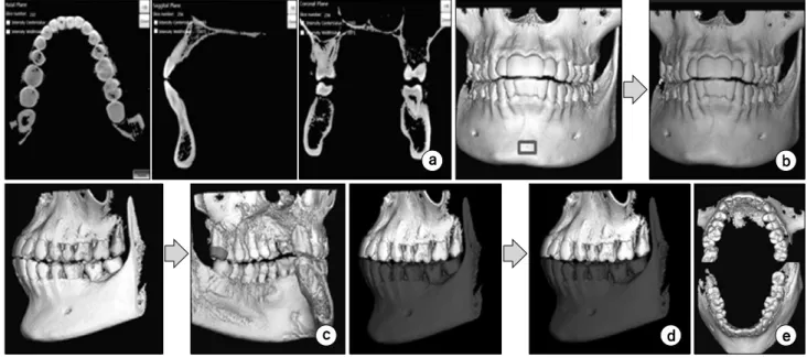 Fig.  10.  The  method  extracting  the  maxilla  and  mandible  (a)  Image  segmentation  (b)  3D  Seeded  region  growing  (c)  Object  separation  (d)  Object  combination  (e)  Extracting  result  of  maxilla  and  mandible.