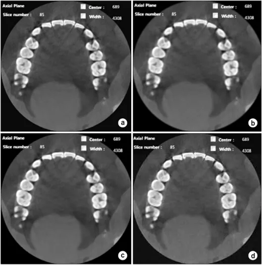 Fig.  3.  Results  of  applying  noise  reduction  filter  to  dental  CBCT  data.  (a)  Original  image  (b)   Gau-ssian  filter  (c)  Median  filter  (d)  Adaptive  total  variation  method.
