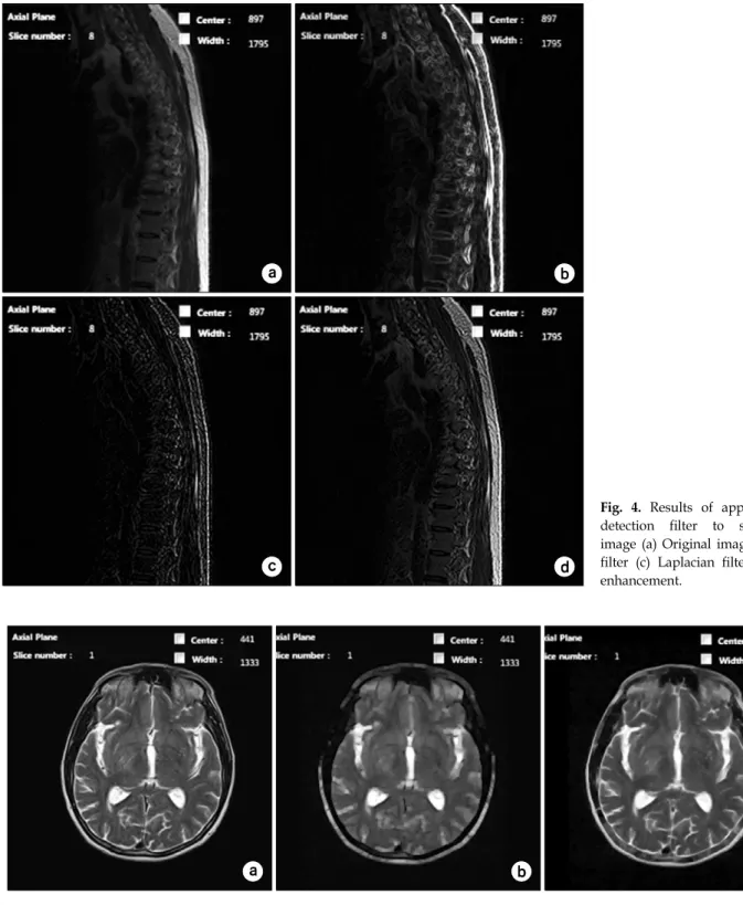 Fig.  4.  Results  of  applying  edge  detection  filter  to  spinal  MR  image  (a)  Original  image  (b)  Sobel  filter  (c)  Laplacian  filter  (d)  Edge  enhancement.