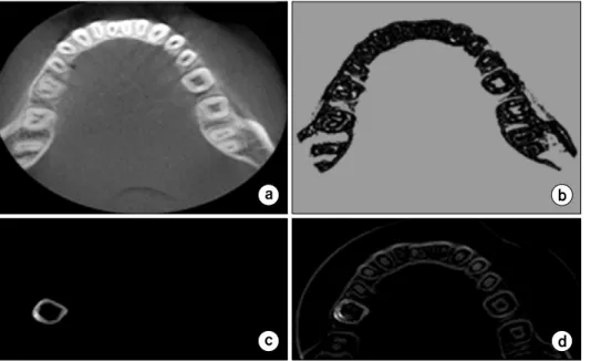 Fig.  6.  Results  of  dental  segmen- segmen-tation  using  region  adaptive  snake  algorithm  (a)  Original  image  (b)  Threshold  image  for  energy   func-tion  (c)  Segmented  contour  in  a  tooth  (d)  A  set  of  segmented   con-tour.