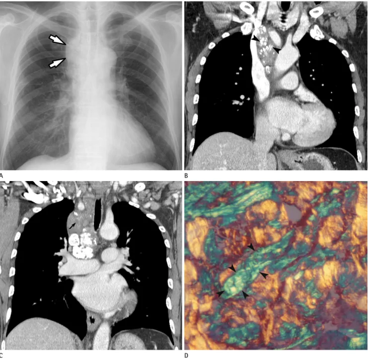 Fig. 1. A 68-year-old man with primary amyloidosis involving mediastinal and cervical lymph nodes