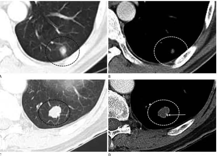Fig. 3. Chest CT scans of two patients who were considered to have pulmonary metastases.