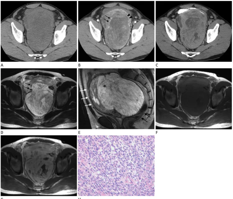 Fig. 1. The synovial sarcoma in the rectovesical space of a 48-year-old man.