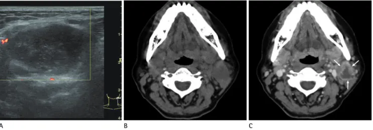 Fig. 1. A 51-year-old female with multifocal Warthin's tumors. 
