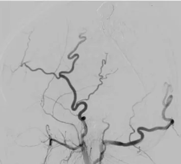 Fig. 5. Lateral projection images from the right ECA angiography after  embolization show effective devascularization of the lesion.