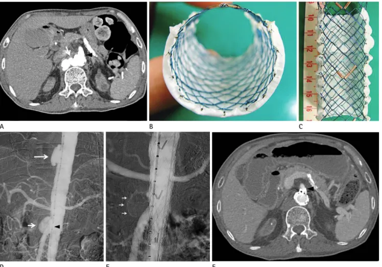 Fig. 1. A. Axial computed tomography (CT) scan shows pseudoaneurysm on the right side of the aorta (7 o’clock, arrow) at the level of superior  mesenteric artery (12-1 o’clock, black arrowhead)