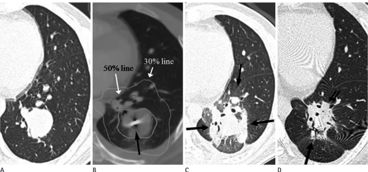 Fig. 3. A 29-year-old man with sarcoma metastasis, 52 Gy/ 3 fractions.