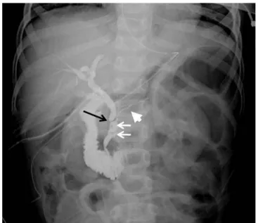 Fig.  2.  CT coronal image shows diffuse ascites distributed in whole  abdomen, and there is no biliary dilatation.