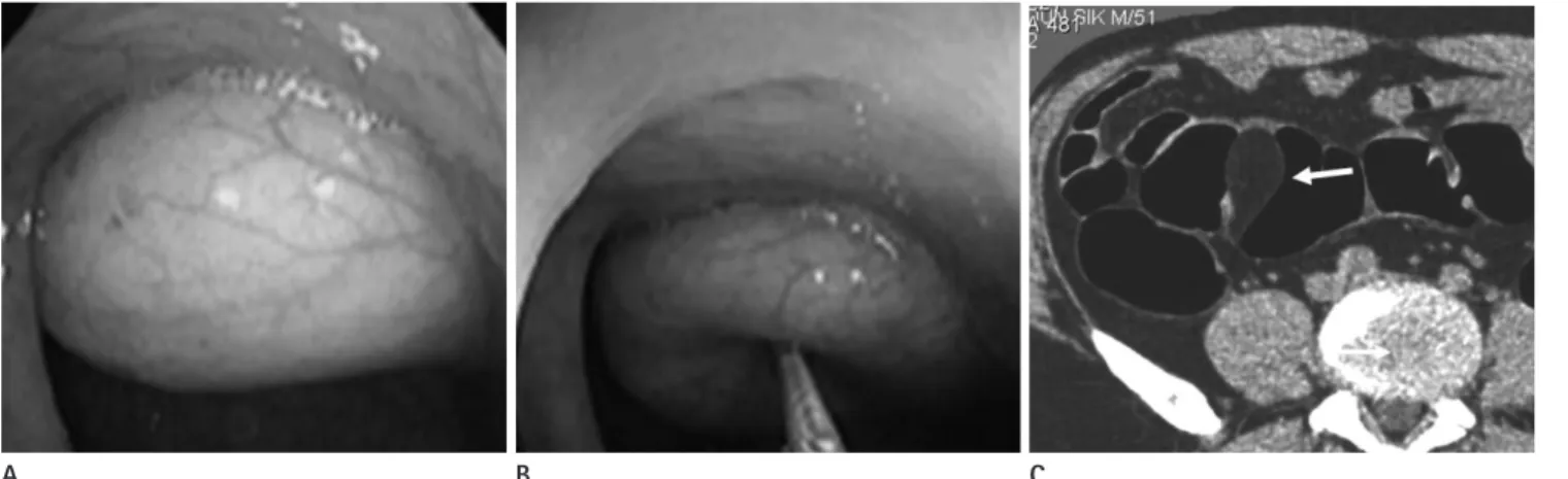 Fig. 3. Lipoma of the sigmoid colon in a 51-year-old man. 