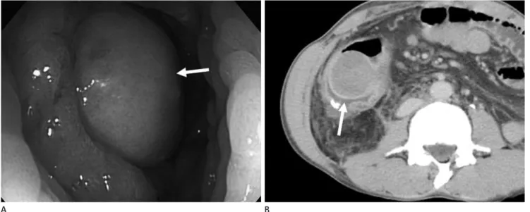 Fig. 5. Inflammatory fibroid polyp of the ascending colon in a 35-year-old man. 