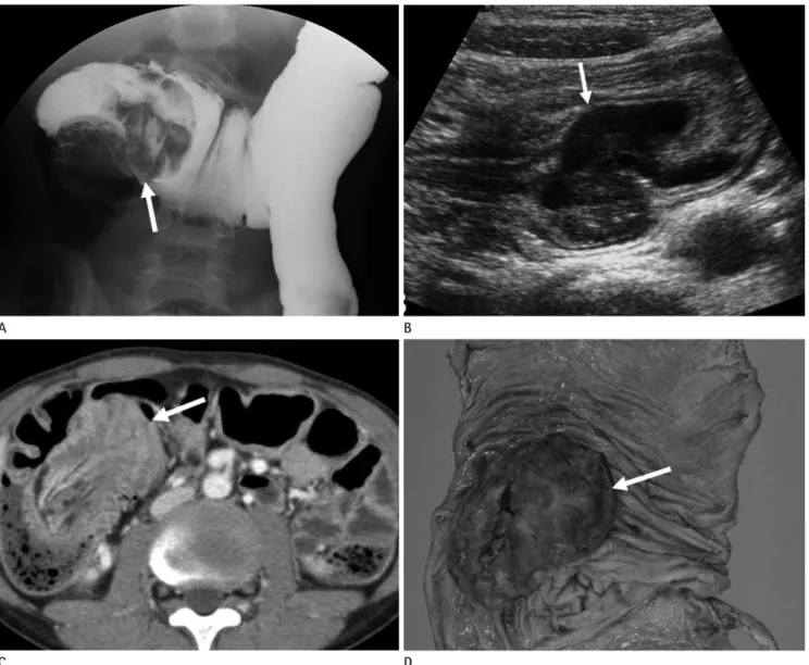 Fig. 6. Polypoid primary lymphoma of the cecum in an 18-year-old man. 
