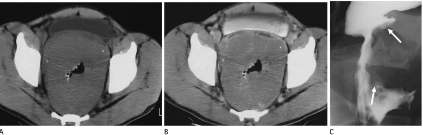 Fig. 7. Circumferential infiltrative primary lymphoma of the rectum in a 29-year-old man.