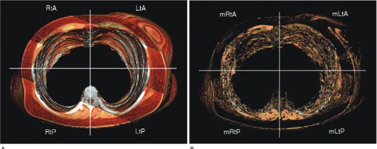 Fig. 2. Measured volume of the chest wall by 3D reconstructed volume rendering image of chest MDCT