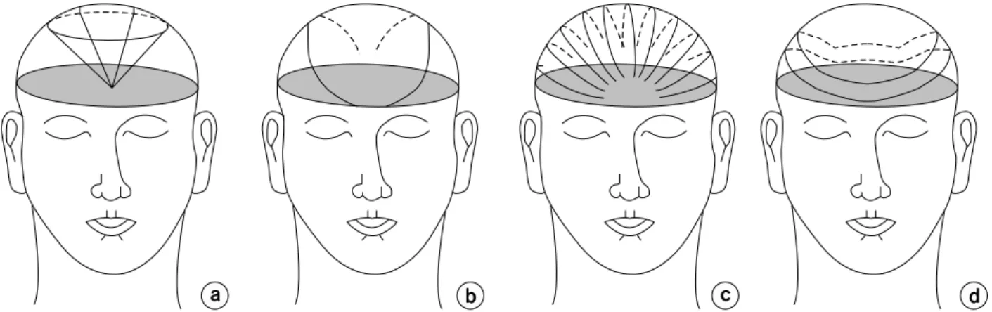 Fig.  1.  Showing  the  pattern  of  stereotactic  moving  beams.  The  dynamic  conversing  beam  (a),  dynamic  arc  conversing  beam  (b),  Non-coplarnar  multiarcs  (c)  and  combined  trans-multiple  arc  beams  (d).