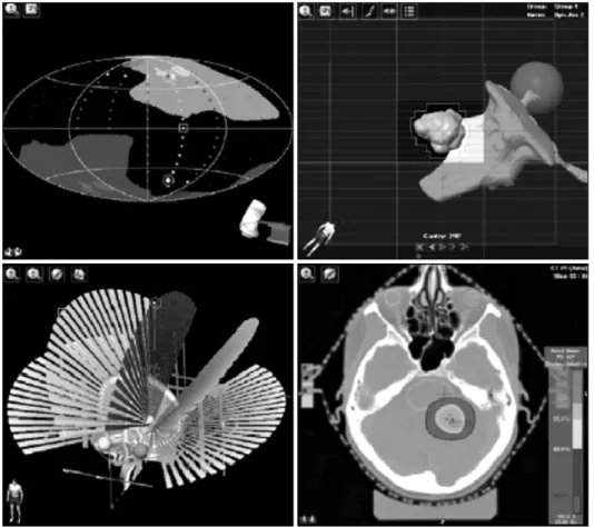 Fig.  8.  Collimation  for  Target  Beam's  eye  view  of  angle  (upper  left)  and  its  mMLC  fited  (upper  right),  and  5  multiarcs  (lower  left)  and  its  dose  distrbutions  in  Brain  Lab.