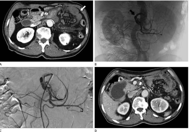 Fig. 1. 71-year-old man suddenly experienced periumbilical pain. The symptom duration time was 18.5 hours.