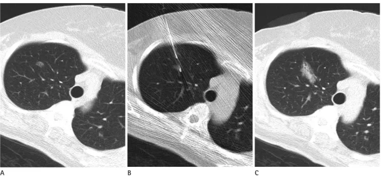 Fig. 1. CT fluoroscopy-guided core biopsy in a 59-year-old woman.